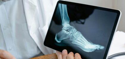 Chirurgia palca – skuteczne leczenie zmian w obrębie stopy